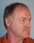 Before Hair Transplant&nbsp;2 Sessions (Areas)